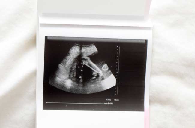 image of ultrasound for article about the legal ramifications of using substances while pregnant for Gulf Breeze Recovery Non-12 step holistic drug and alcohol rehab in Florida